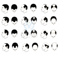 【Ebpay基因检测】过早<font color='red'>脱发</font>、掉发太多怎么办？你的方法可能是错的！